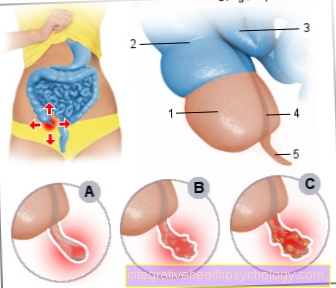 Ilustración apendicitis