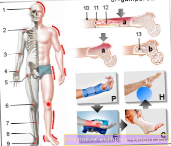 Figure bone bruise