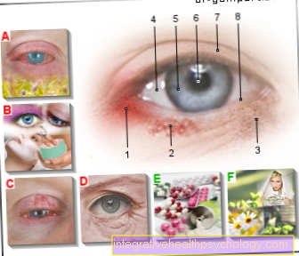 Figura eczema no olho
