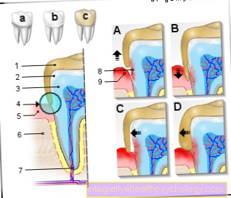 Figure inflammation under the tooth crown