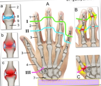 Slika osteoartritisa prsta