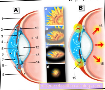 Ilustración de glaucoma (glaucoma)