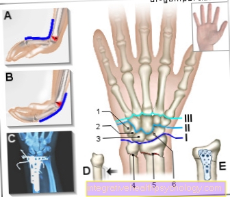 Illustration of a broken wrist