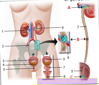 Hình sỏi niệu quản