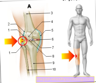 Илустрација сузења спољашњег лигамента колена