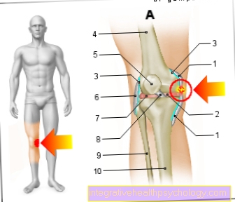 Hình minh họa vết rách dây chằng đầu gối bên trong