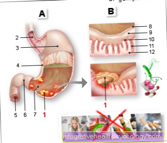 Illustration gastrisk mavesår