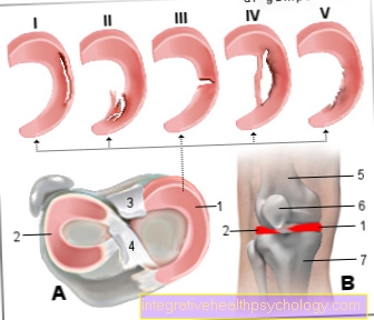 Figure meniscus tear