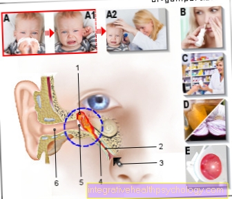 Illustration otitis media