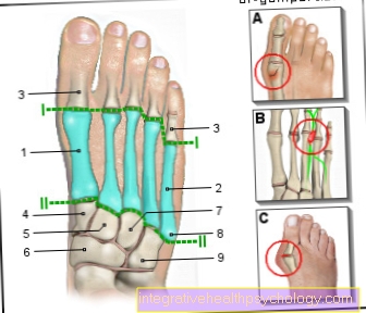 Ilustrasi nyeri metatarsal