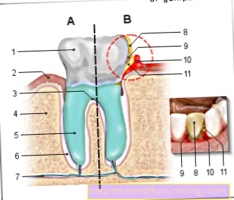 Ilustración gingivitis