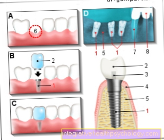 Ilustračný zubný implantát