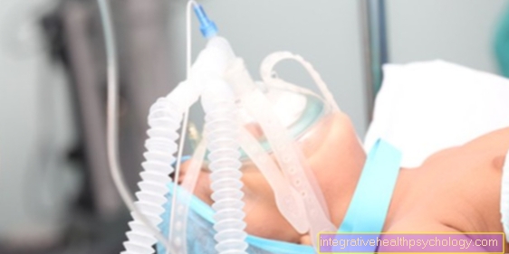 Intubációs érzéstelenítés