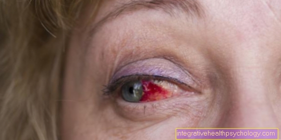 Tumor conjuntival