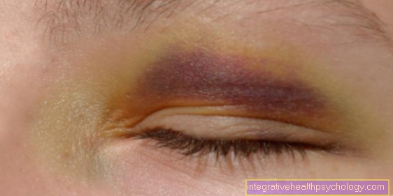 Hematoma oftálmico