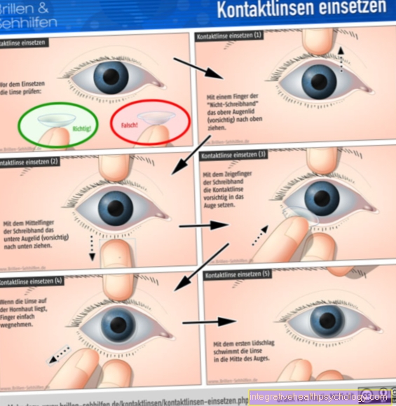 La inserción de lentes de contacto