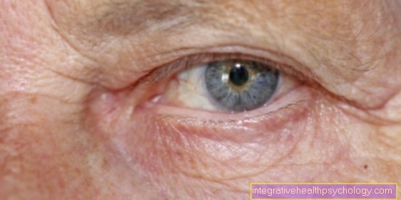 Corneal edema in the eye