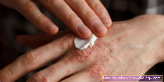 Behandling af atopisk dermatitis