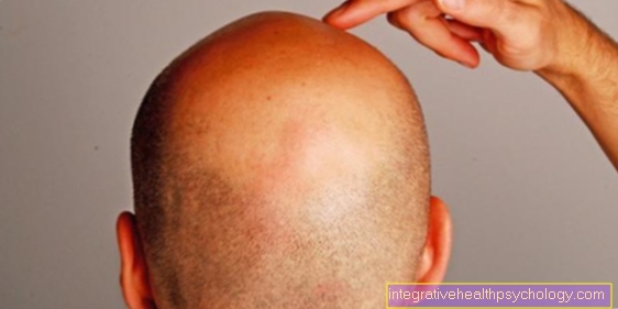 Psoriasis of the scalp