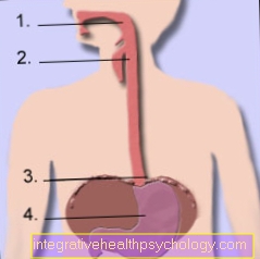 Achalasia