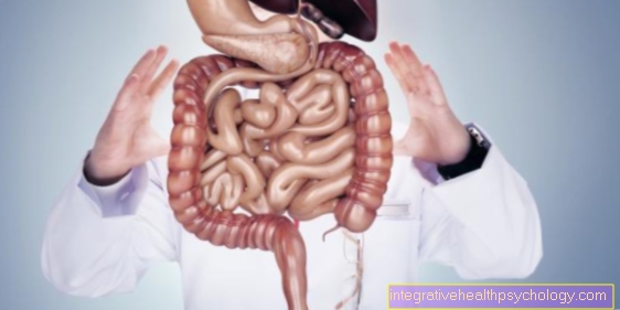 diverticulitis