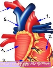 Tetralogía de Fallot