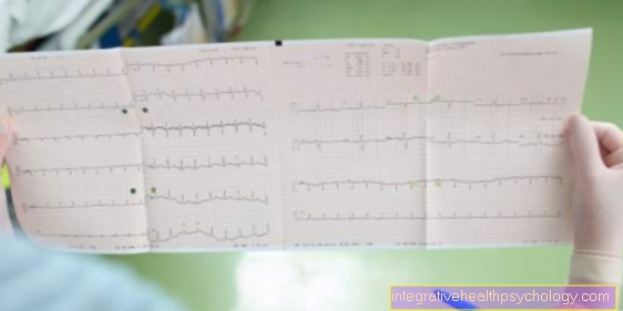 Heart muscle inflammation on the EKG