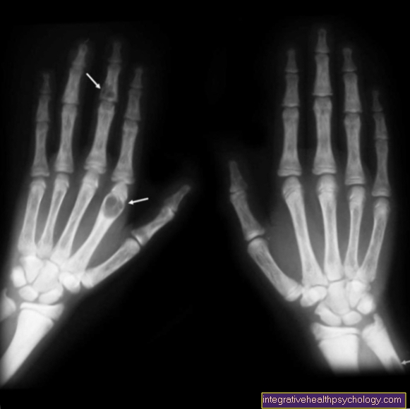 Hyperparathyreoidismus