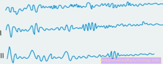 Ventricular flutter and ventricular fibrillation