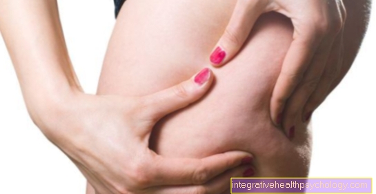 Lipedema - ฉันจะบอกได้อย่างไร?