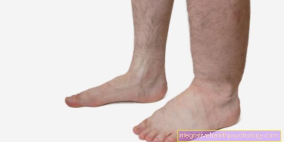 A lábak lymphedema