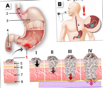 Cáncer de estómago