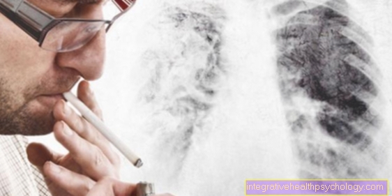 ¿Carcinoma de células escamosas de los pulmones?