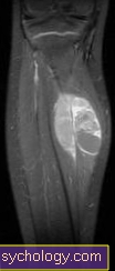 Rhabdomyosarcoma