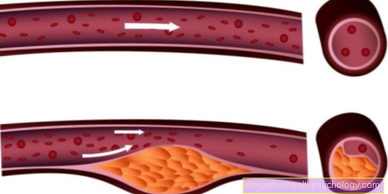 Atherosclerosis tünetei