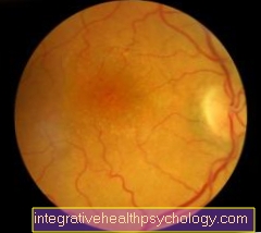 Trombóza v oku