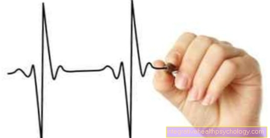 Perubahan apa yang dapat dilihat pada EKG dengan fibrilasi atrium?