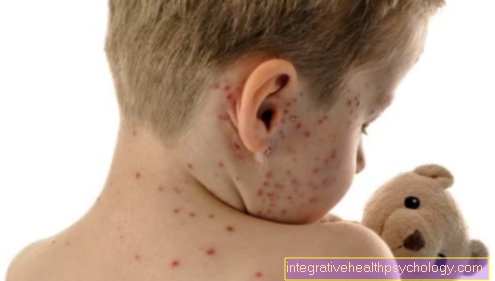 Chickenpox rash