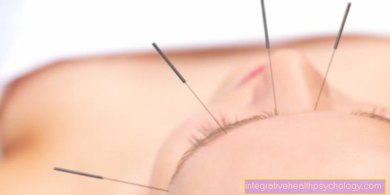 Acupuncture for weight loss