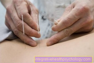 Trigger point acupuncture