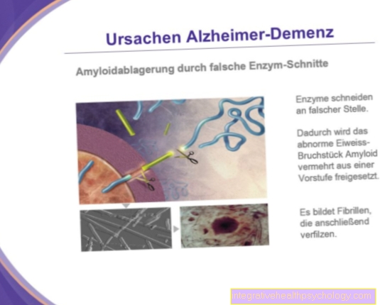 Causes of Alzheimer's Disease