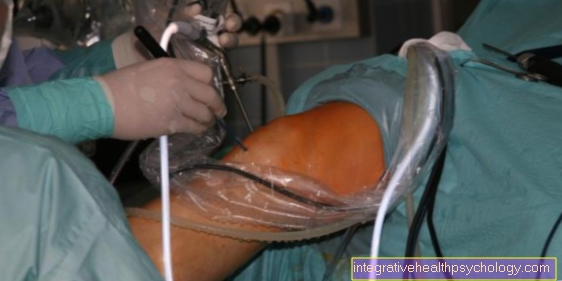 Arthroscopy ของข้อเข่า