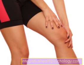 Зовнішня розтягнення зв’язок коліна