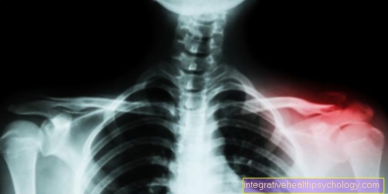 Clavicle fracture