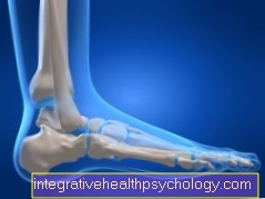 Fatigue fracture in the metatarsus