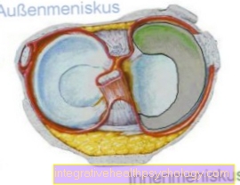 Kerusakan meniskus