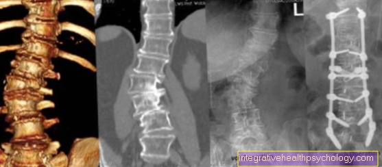 การผ่าตัด Scoliosis