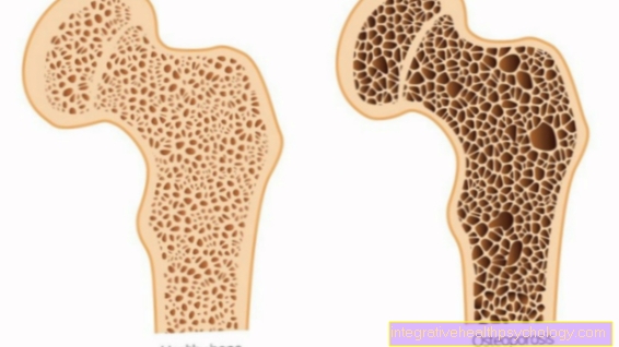 osteoporóza