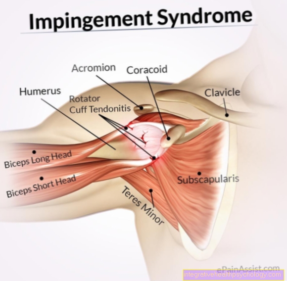 Fisioterapia para el síndrome de pinzamiento