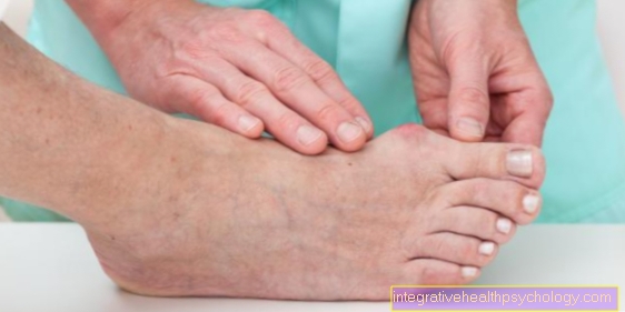 Tapning af en hallux valgus